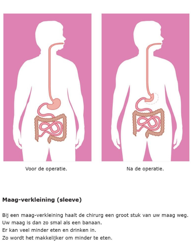 Maagverkleining tieners gratis in het basispakket